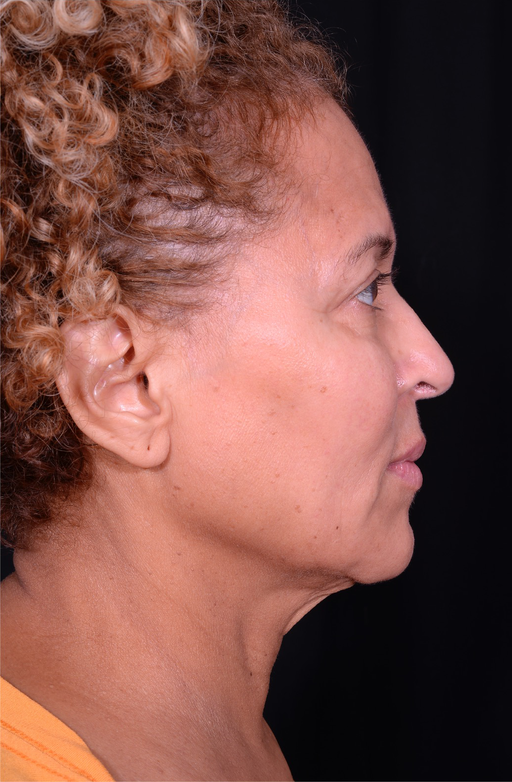 Facelift-Case--360 | Before Facelift 4
