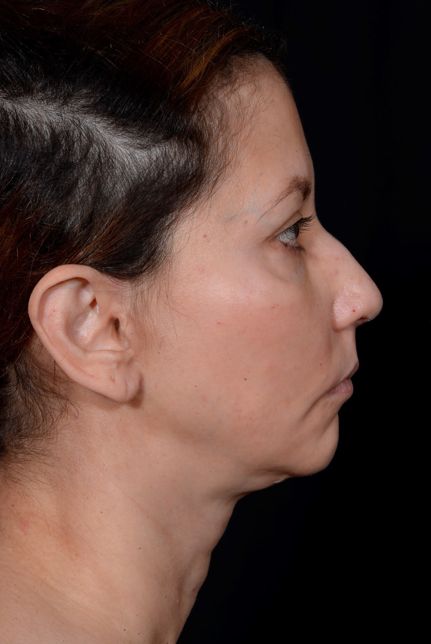 Rhinoplasty-Case--375 | Before Rhinoplasty 2