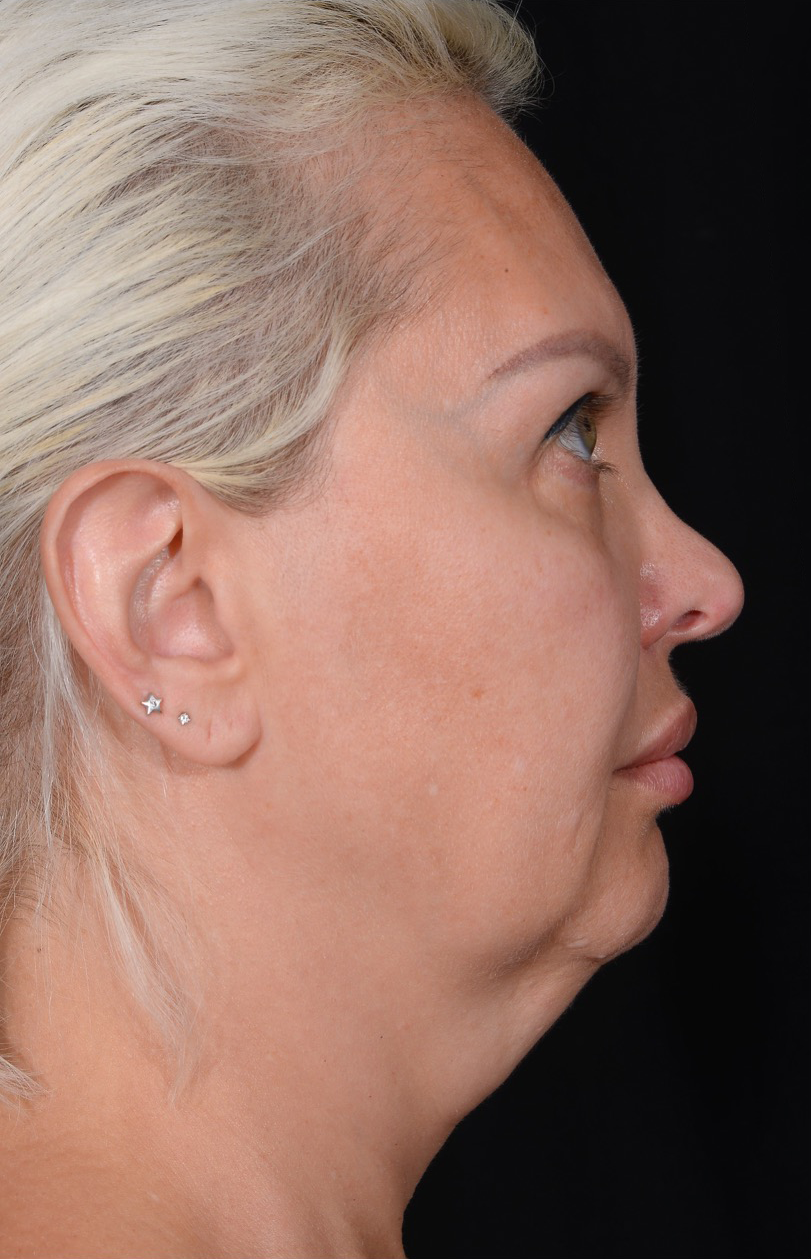 Facelift-Case--362 | Before Dr. Arjun Kanuri 2