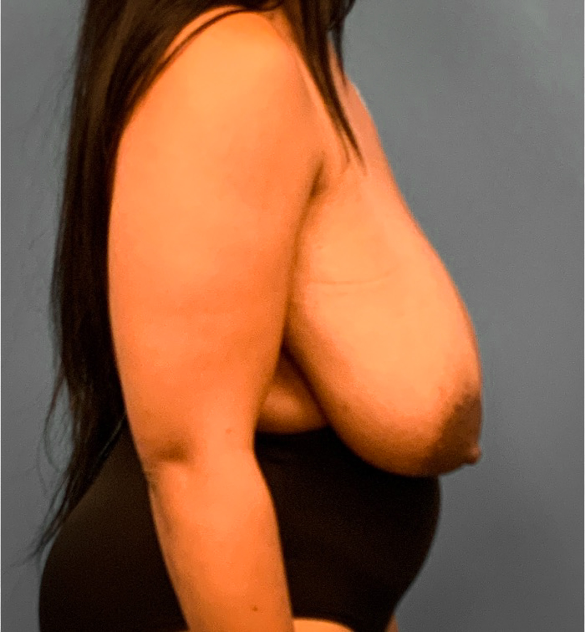 Breast-Reduction-Case--2564 | Before Breast Reduction 3