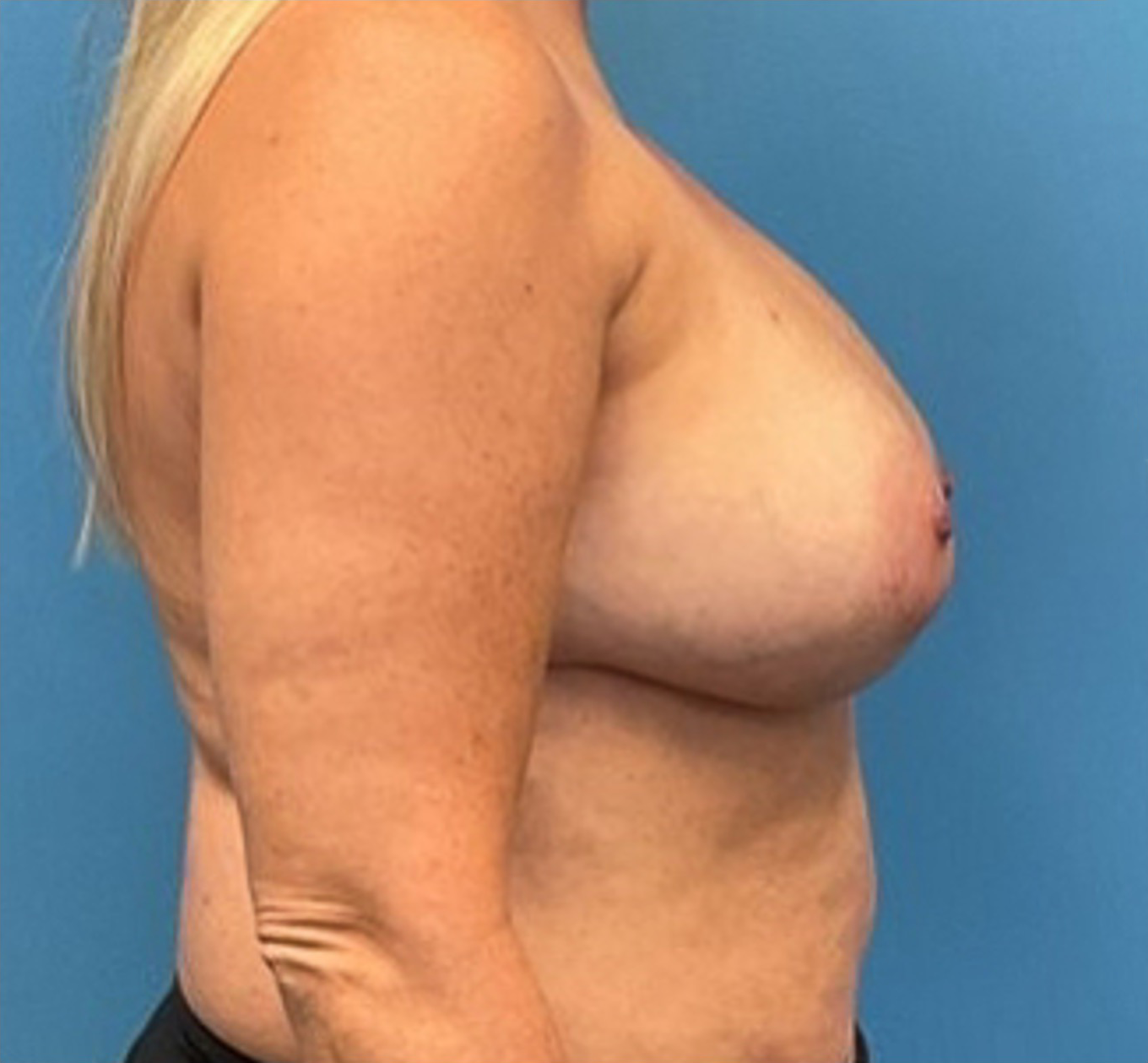 Breast-Reconstruction-Case--25682 | Before Breast Reconstruction 5