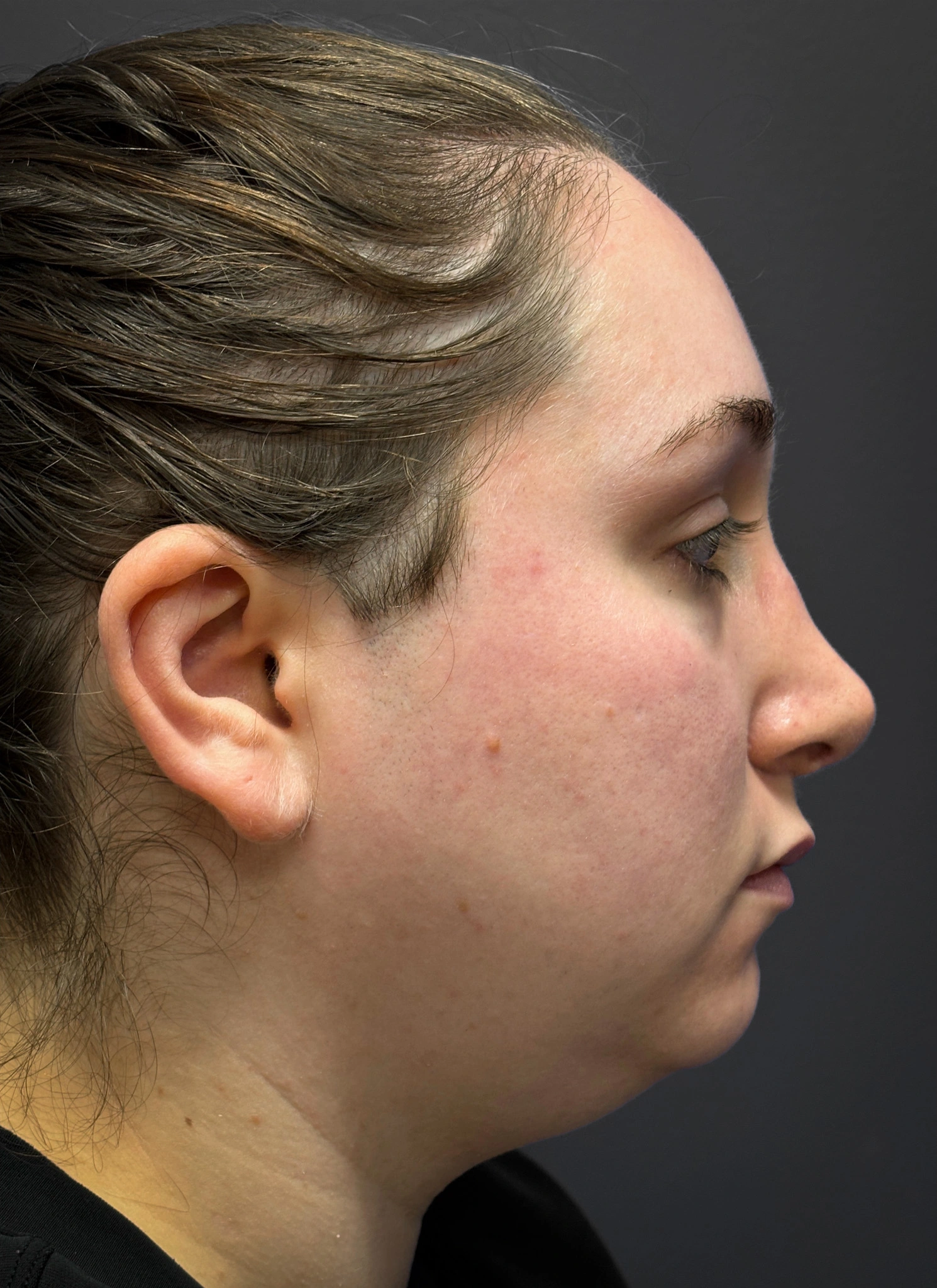 Submental-Liposuction-Case--3439 | Before Face 2