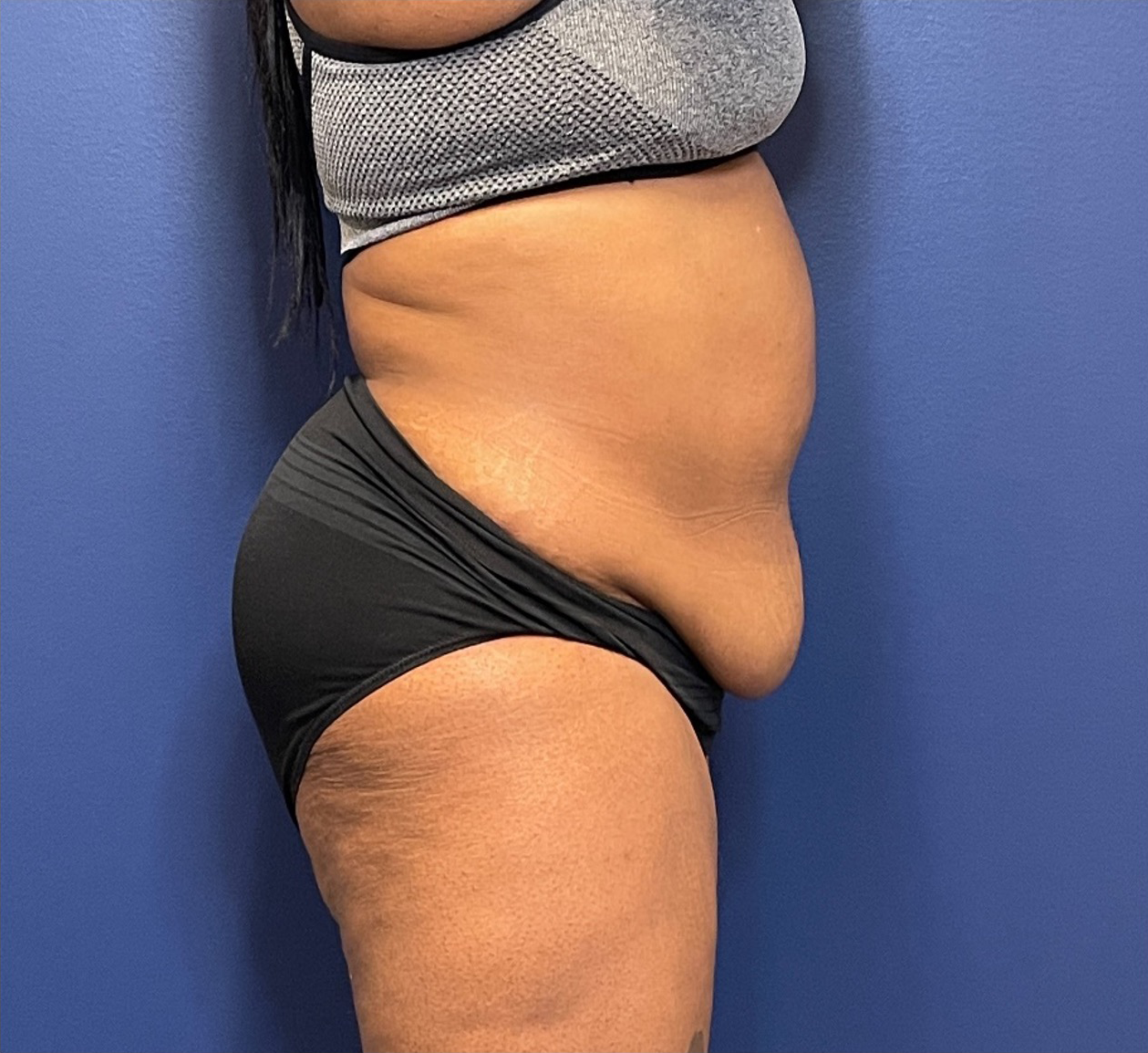 Lipoabdominoplasty-Case--245 | Before Dr. Samir Rao 2