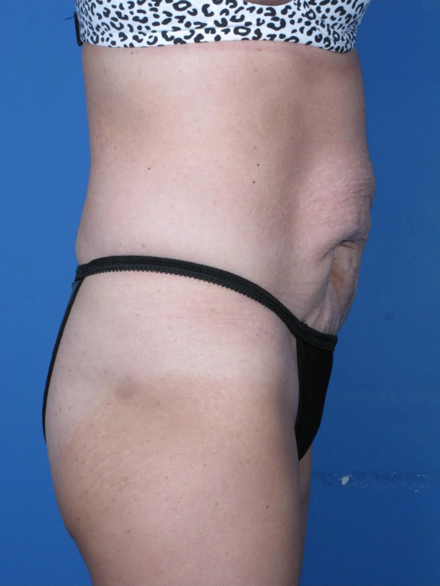 Tummy-Tuck-Case--250 | Before Body 2