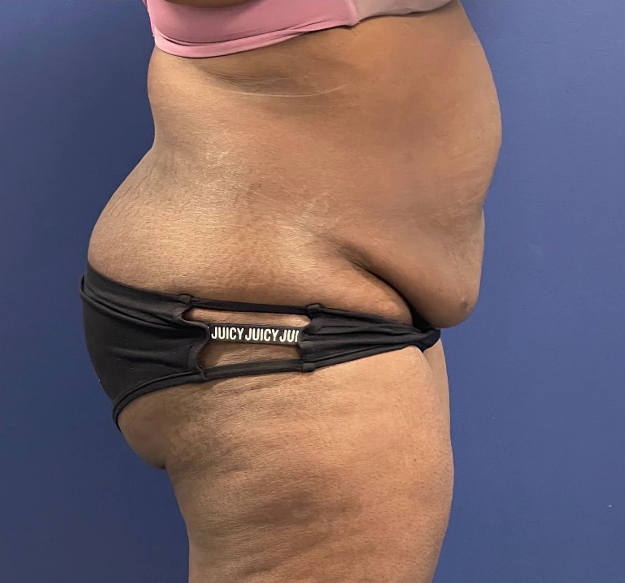 Case--257 | Before Liposuction 3