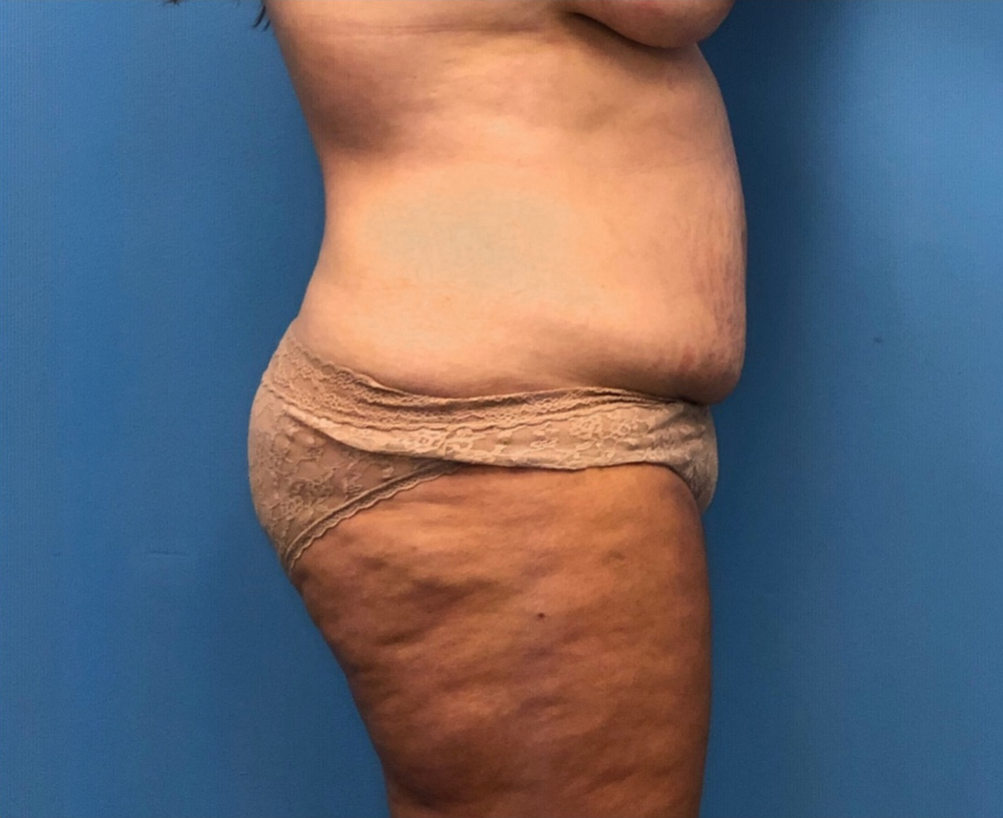 Case--252 | Before Liposuction 2