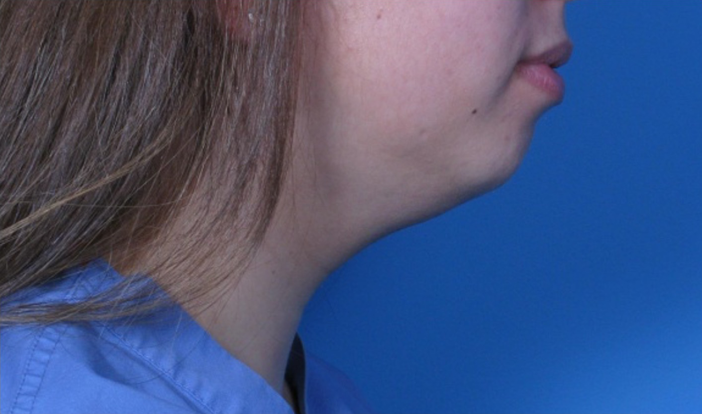 Case--293 | Before Submental Liposuction 3
