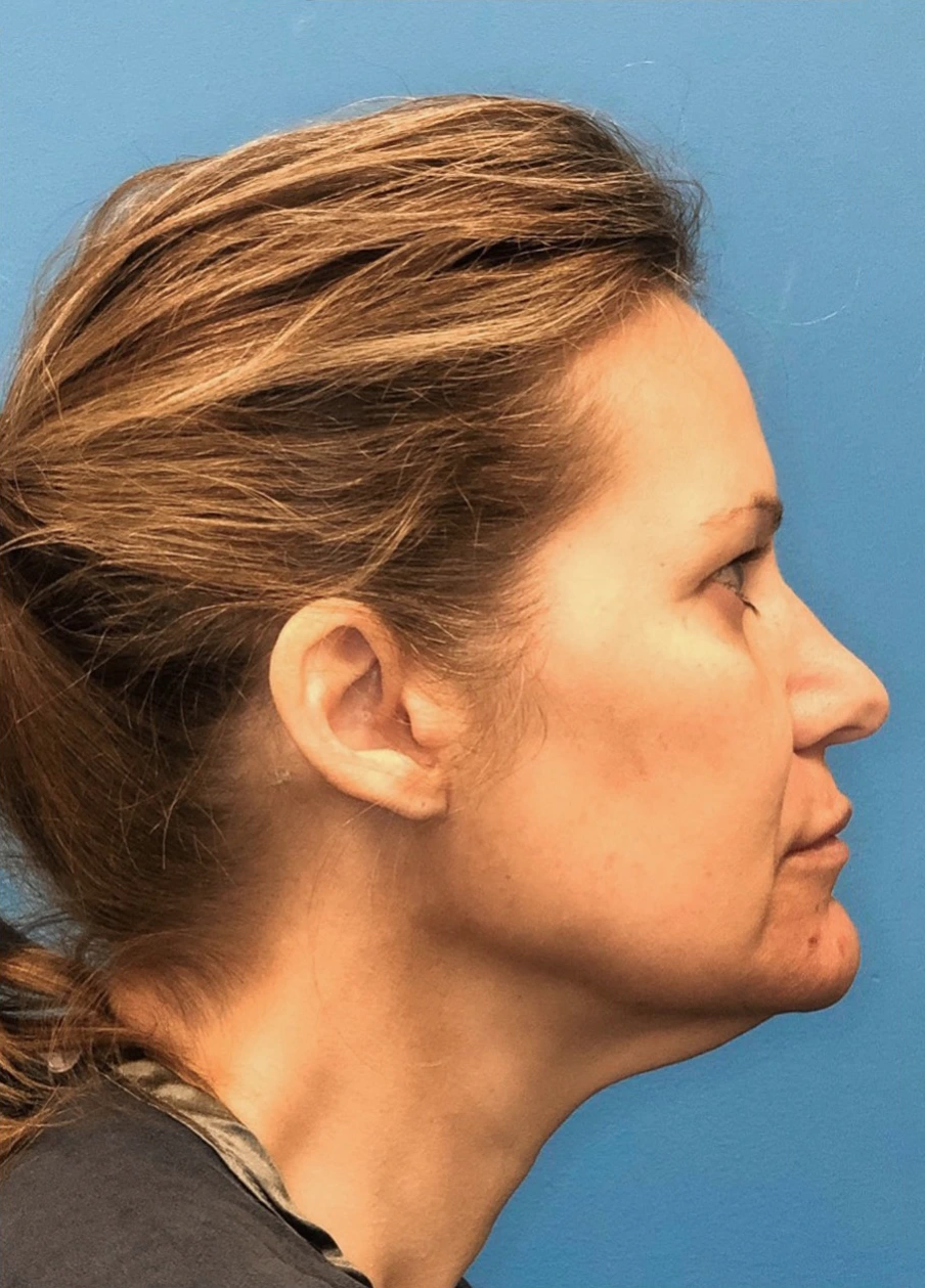 Facelift-Case--18078 | Before Facelift 3