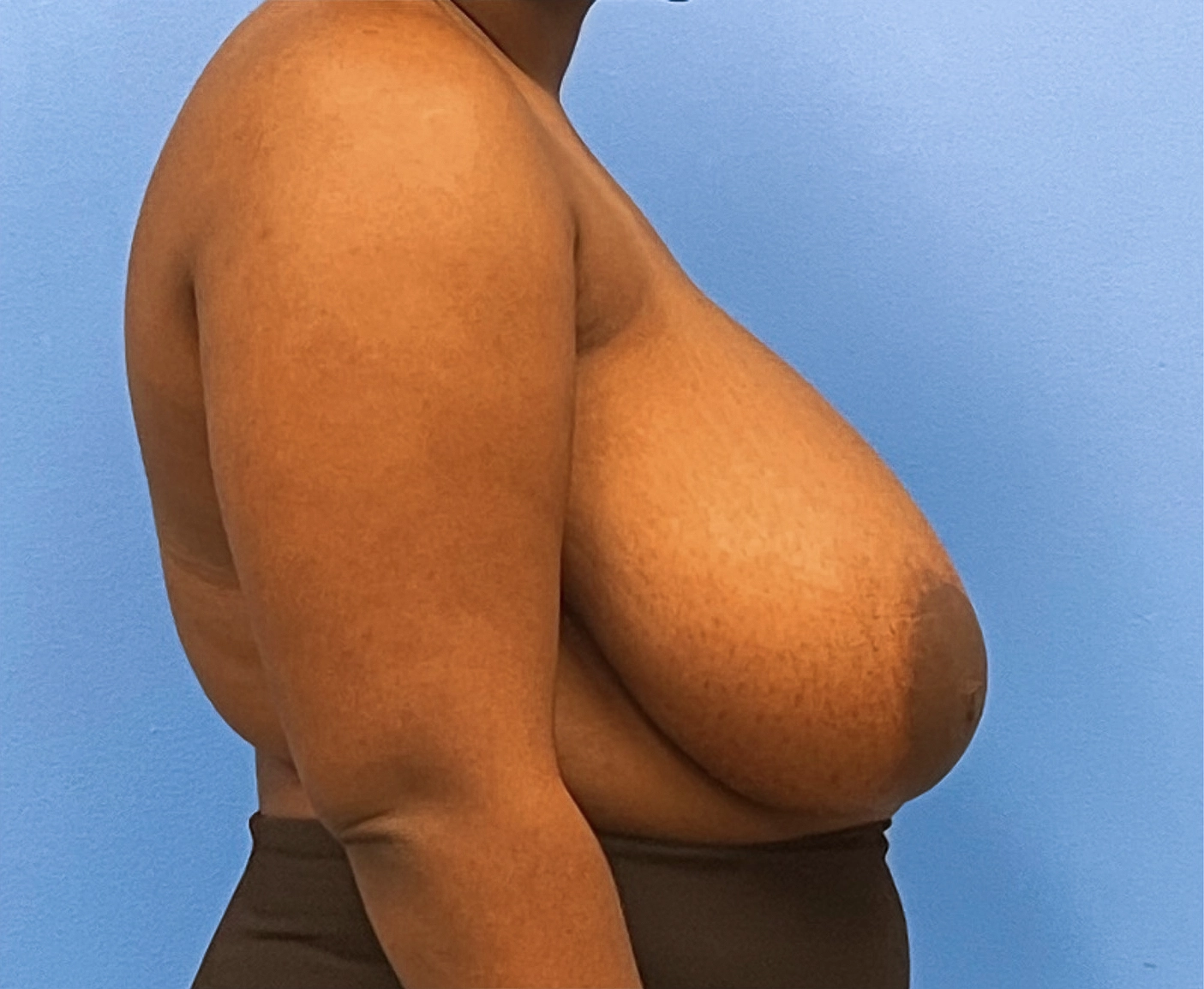Breast-Reduction-Case--240 | Before Breast Reduction 2