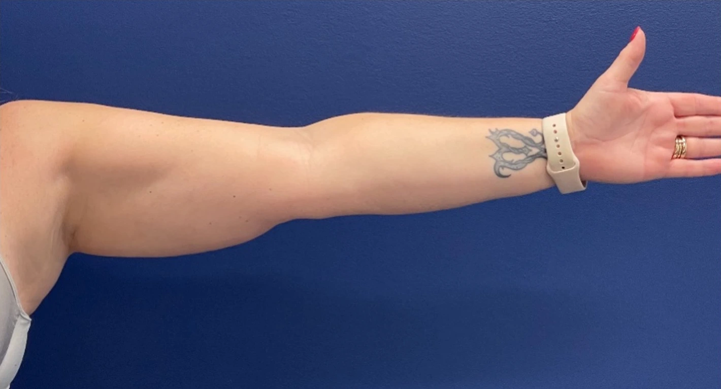Case--399 | Before Liposuction 2