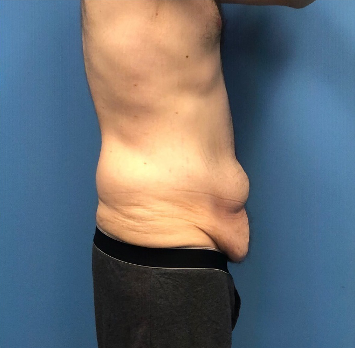Body-Lift-Case--273 | Before Dr. Samir Rao 2