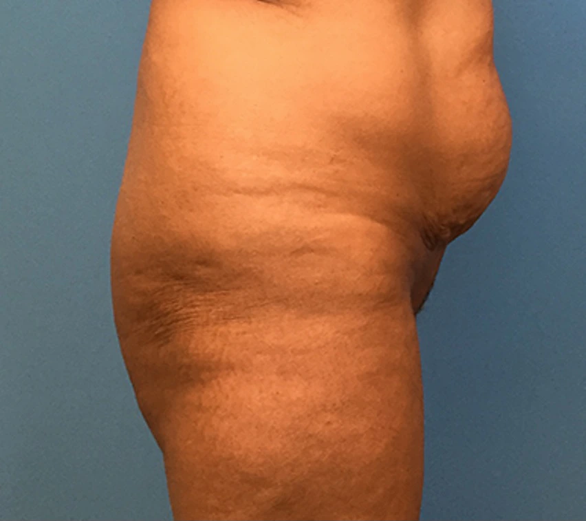 Brazilian-Butt-Lift-Case--74 | Before Brazilian Butt Lift 4
