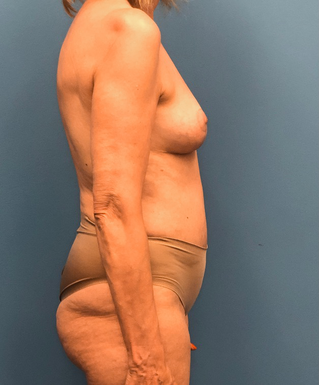 Case--17297 | After Breast Lift 3