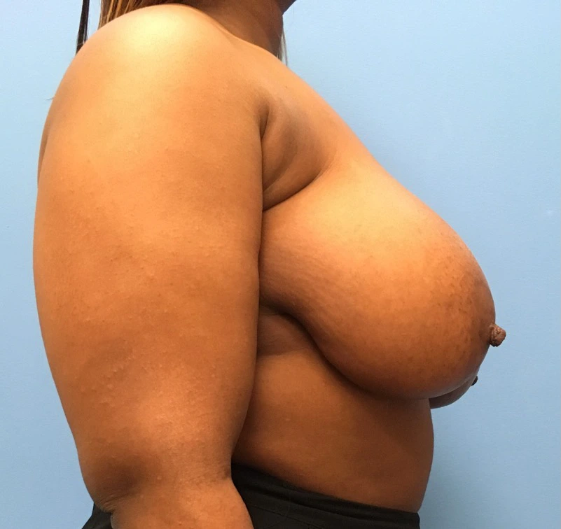 Breast-Reduction-Case--13002 | Before Breast Reduction 3