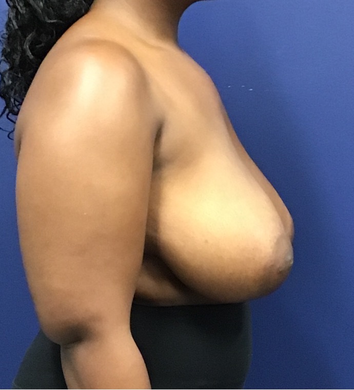 Breast-Reduction-Case--27530 | Before Breast Reduction 5