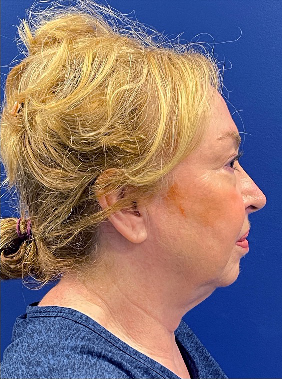 Facelift-Case--22860 | Before Facelift 3