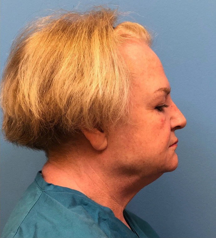 Facelift-Case--14460 | Before Dr. Samir Rao 2