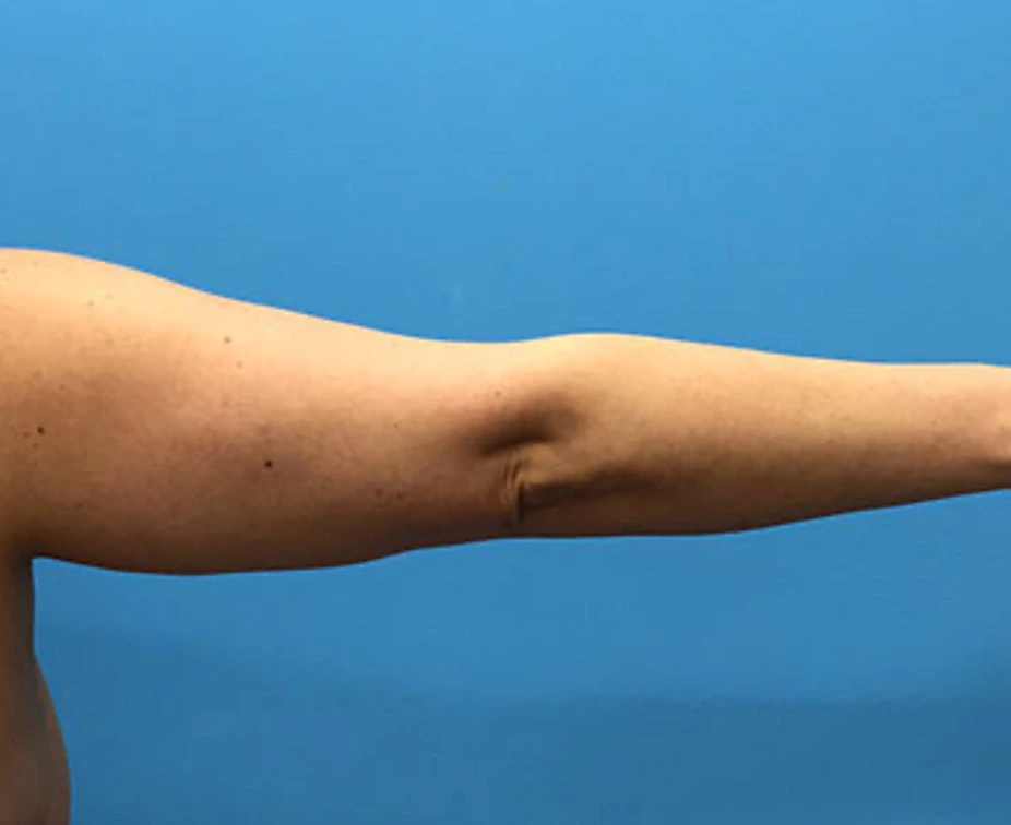 Brachioplasty-Case--78 | Before Arm Lift 2