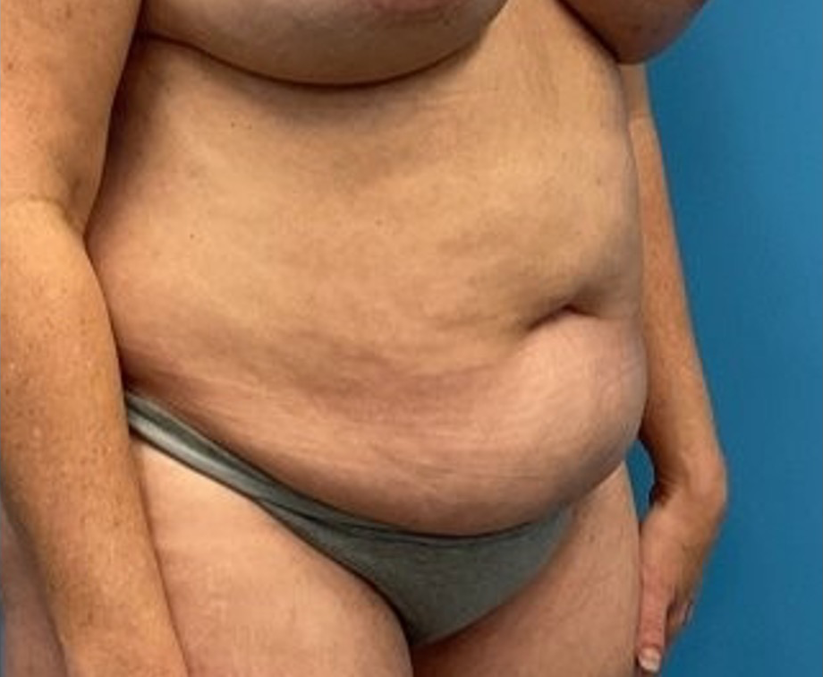 Liposuction-Tummy-Tuck-Case--25682-2 | Before Liposuction 4