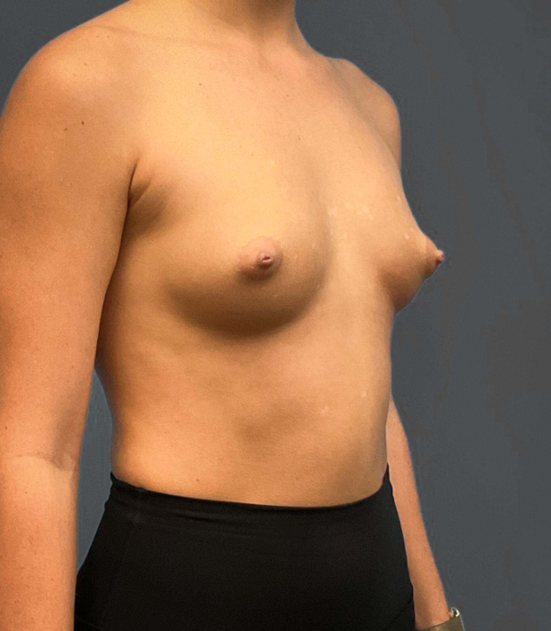 Breast-Augmentation-Case--2384 | Before Breast Augmentation 5