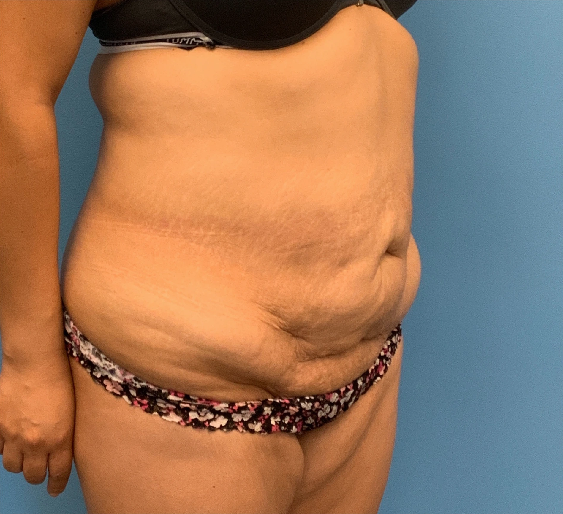 Abdominoplasty-Case--23747 | Before Tummy Tuck 4