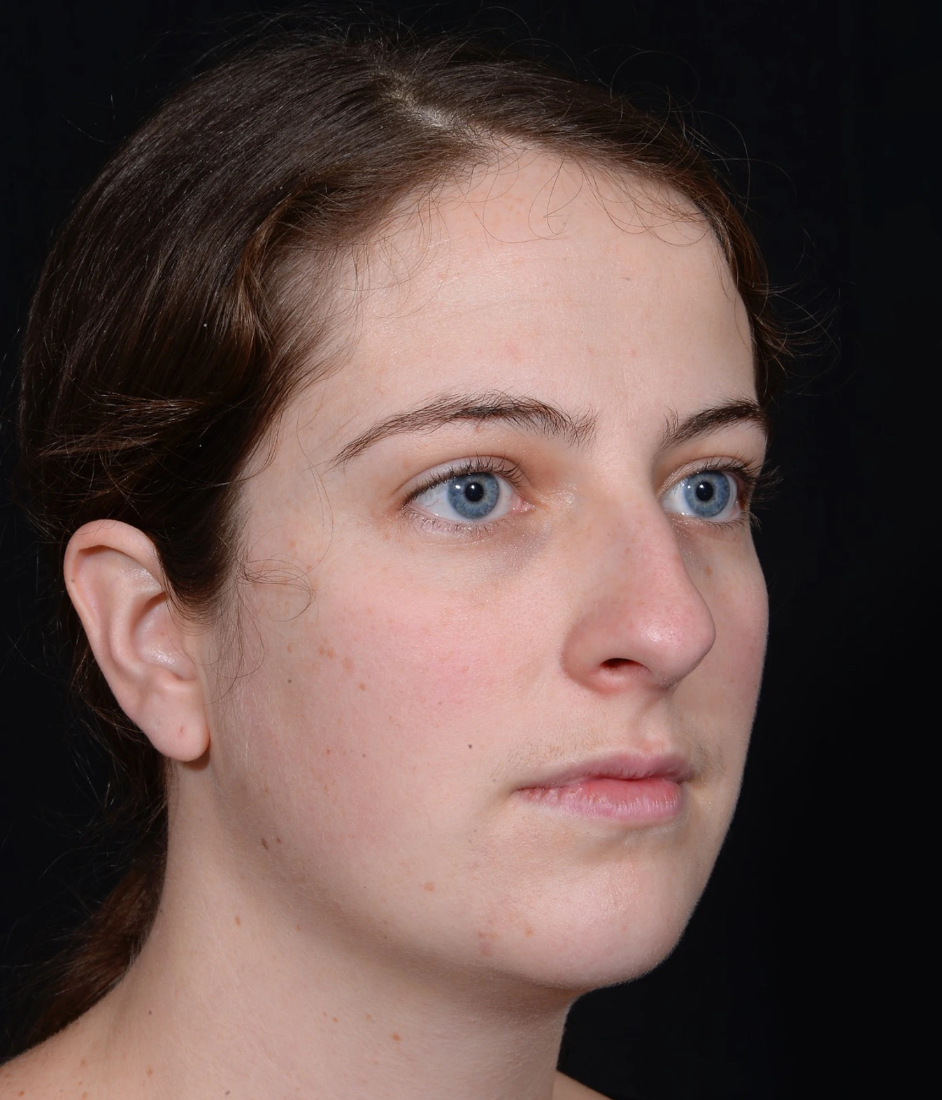 Rhinoplasty-and-Chin-Implant-Case--381 | Before Dr. Arjun Kanuri 2