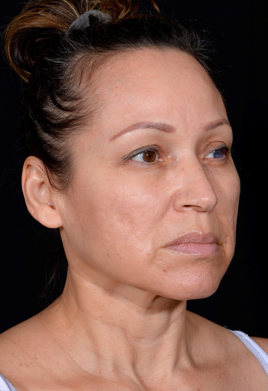 Facelift-Case--364 | Before Face 2