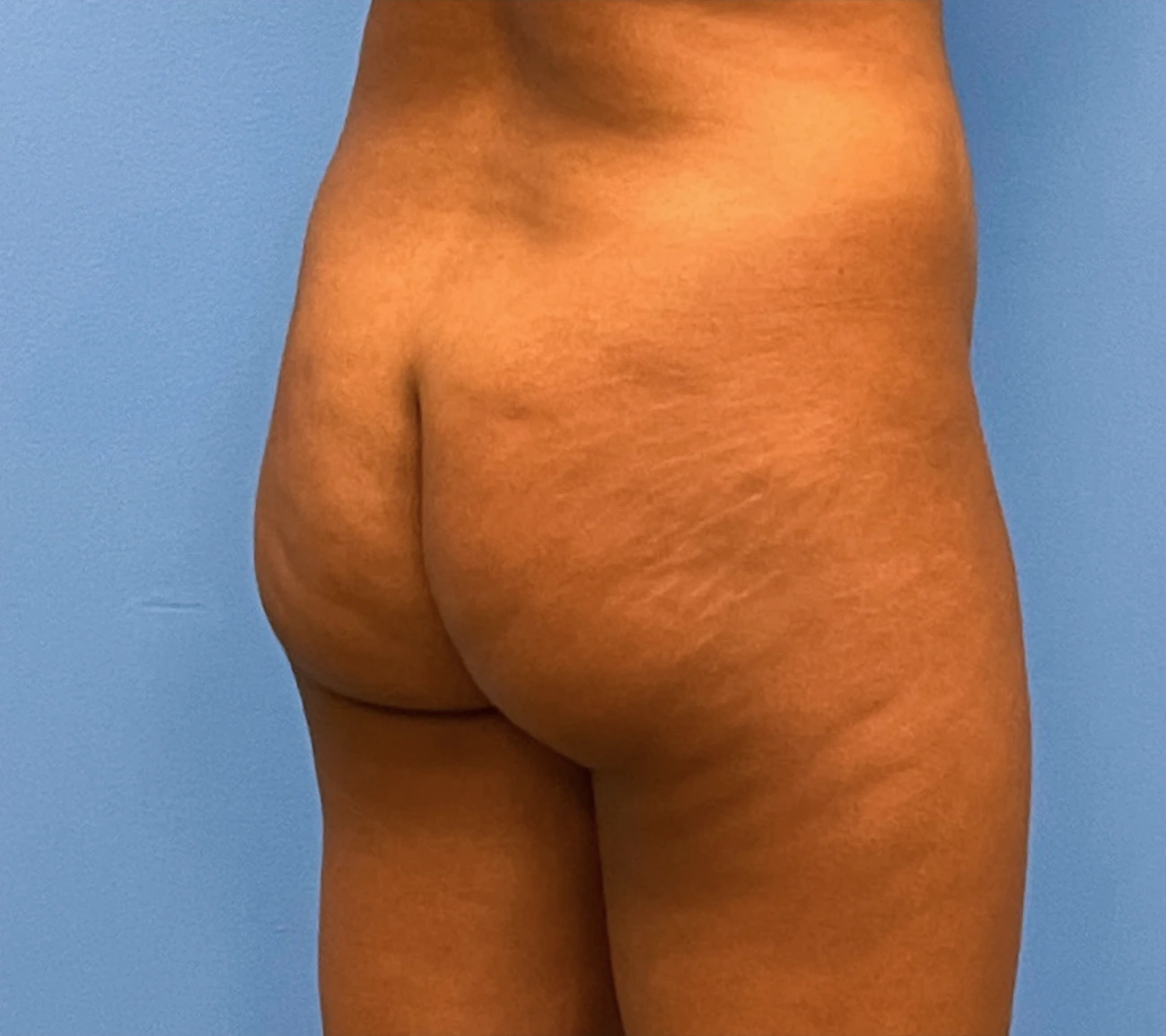 Brazilian-Butt-Lift-Case--263 | Before Brazilian Butt Lift 2