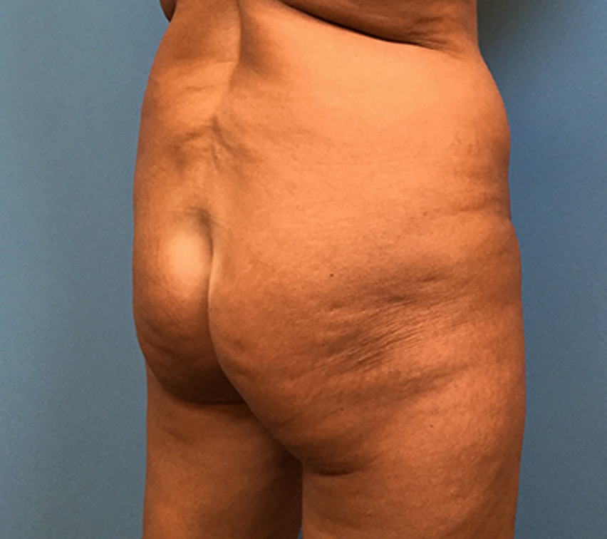 Brazilian-Butt-Lift-Case--74 | Before Brazilian Butt Lift 2