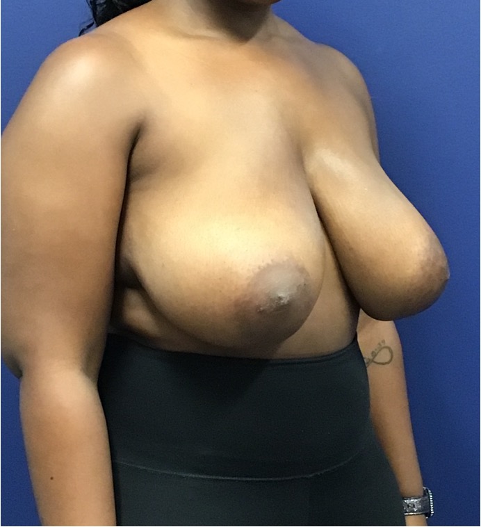 Breast-Reduction-Case--27530 | Before Breast Reduction 4