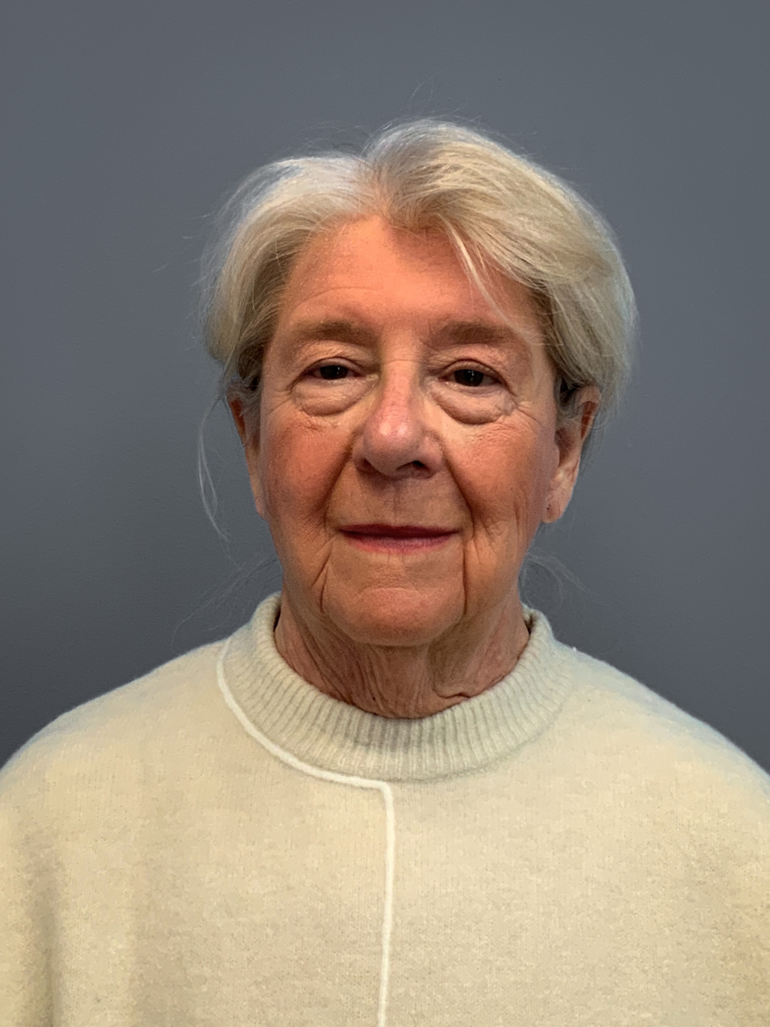 Facelift-360-Facial-Fat-Grafting-and-Necklift-Blepharoplasty-Case--1088 | Before Face 1