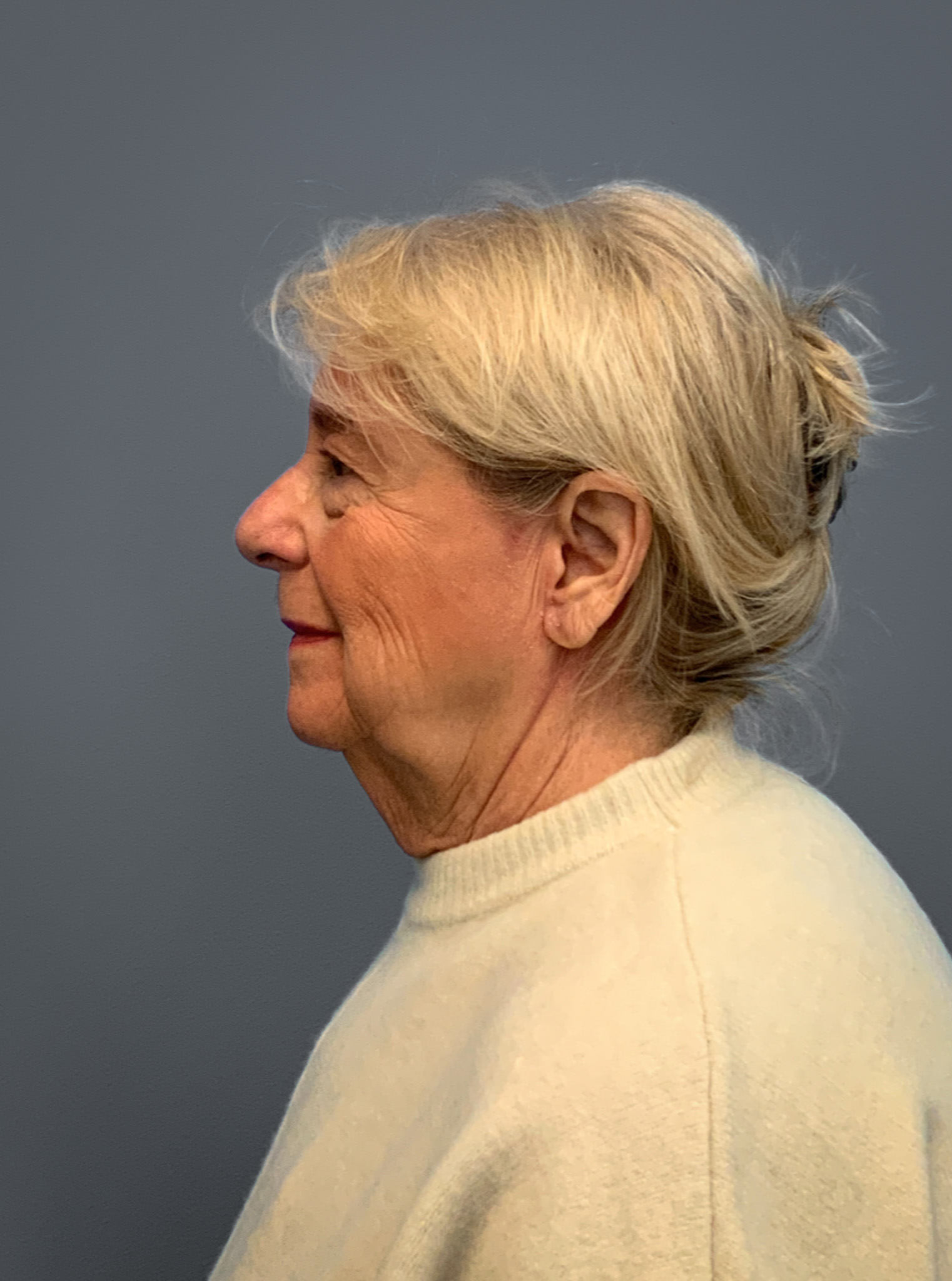 Facelift-360-Facial-Fat-Grafting-and-Necklift-Blepharoplasty-Case--1088 | After Face 2