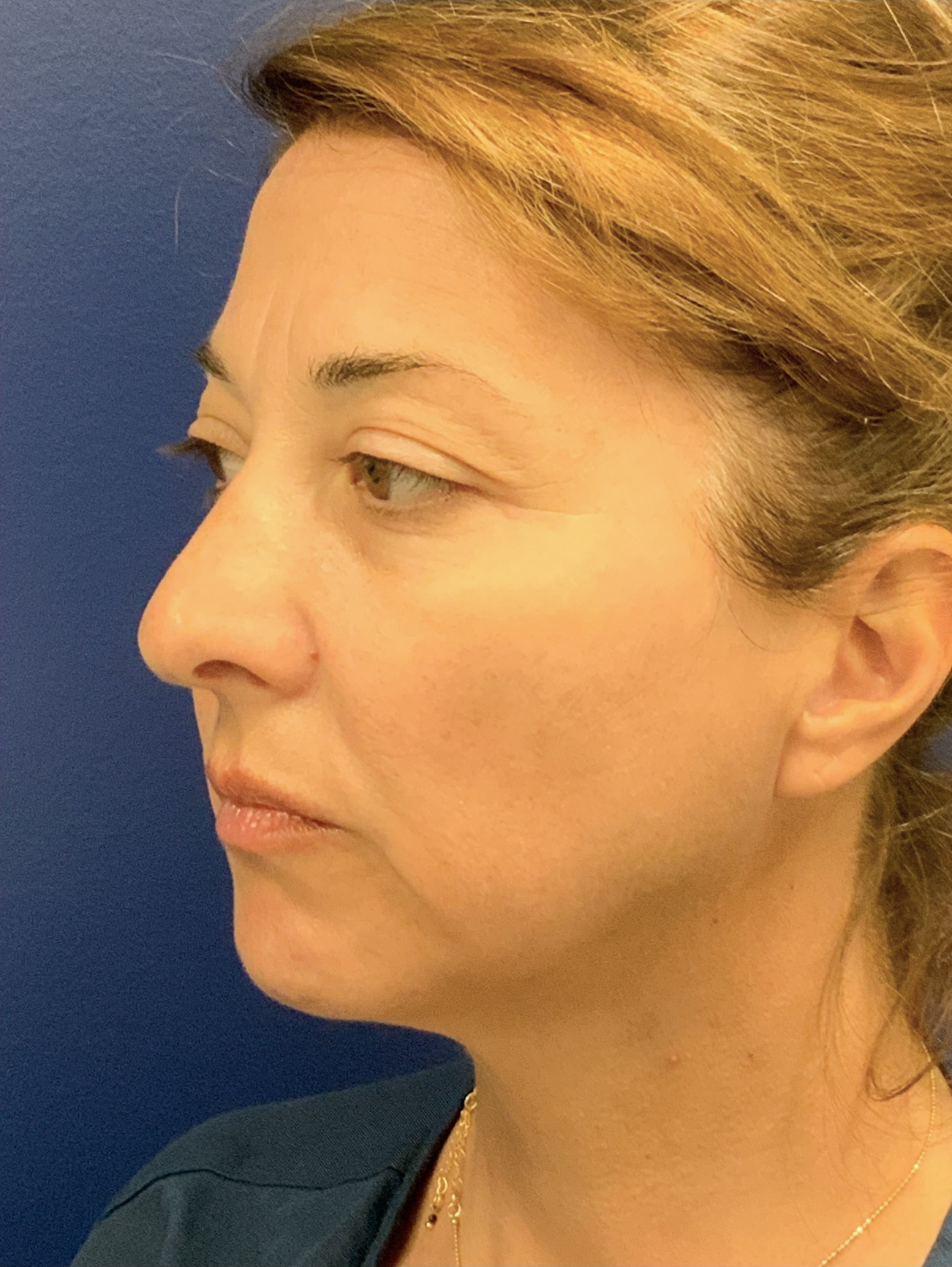 Facelift-360-Facial-Fat-Graft-Blepharoplasty-Neck-Lift-Case--6190 | Before Face360 5