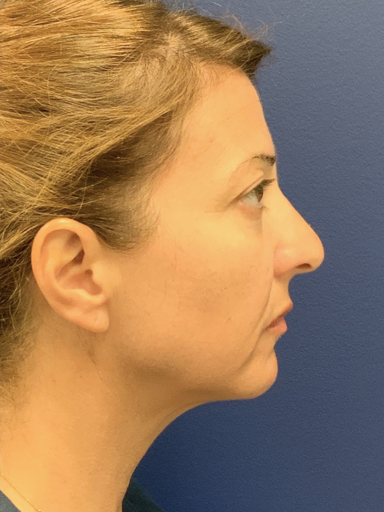 Facelift-360-Facial-Fat-Graft-Blepharoplasty-Neck-Lift-Case--6190 | Before Face360 3