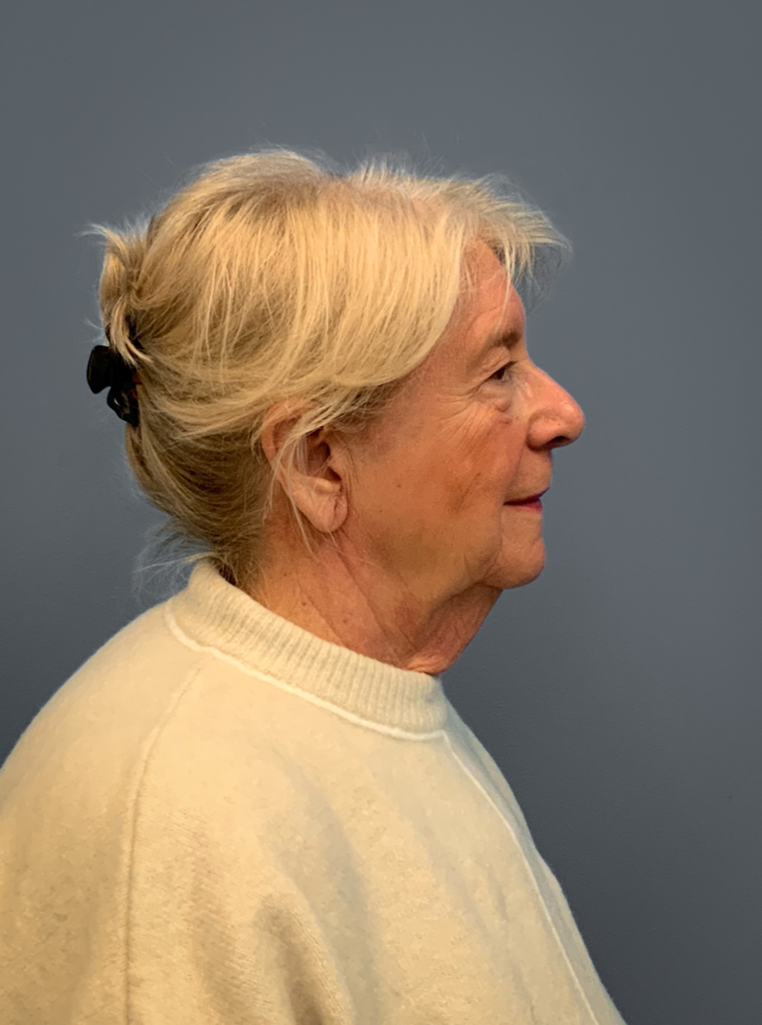 Facelift-360-Facial-Fat-Grafting-and-Necklift-Blepharoplasty-Case--1088 | Before Face 2