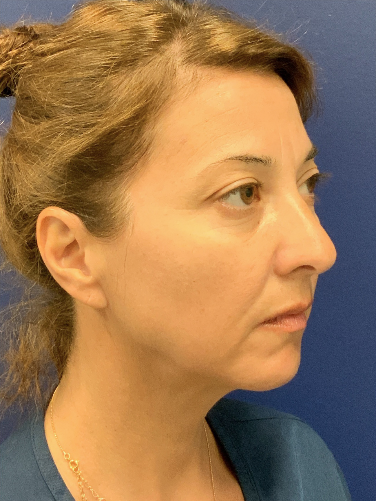 Facelift-360-Facial-Fat-Graft-Blepharoplasty-Neck-Lift-Case--6190 | Before Face360 4