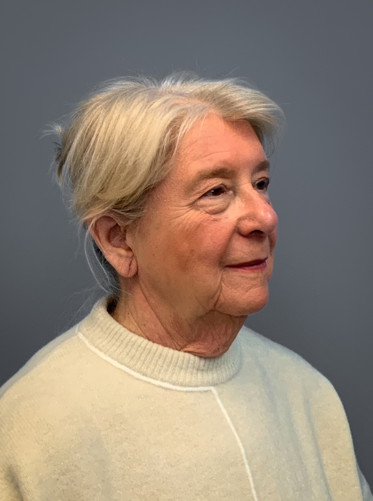 Facelift-360-Facial-Fat-Grafting-and-Necklift-Blepharoplasty-Case--1088 | Before Face360 4