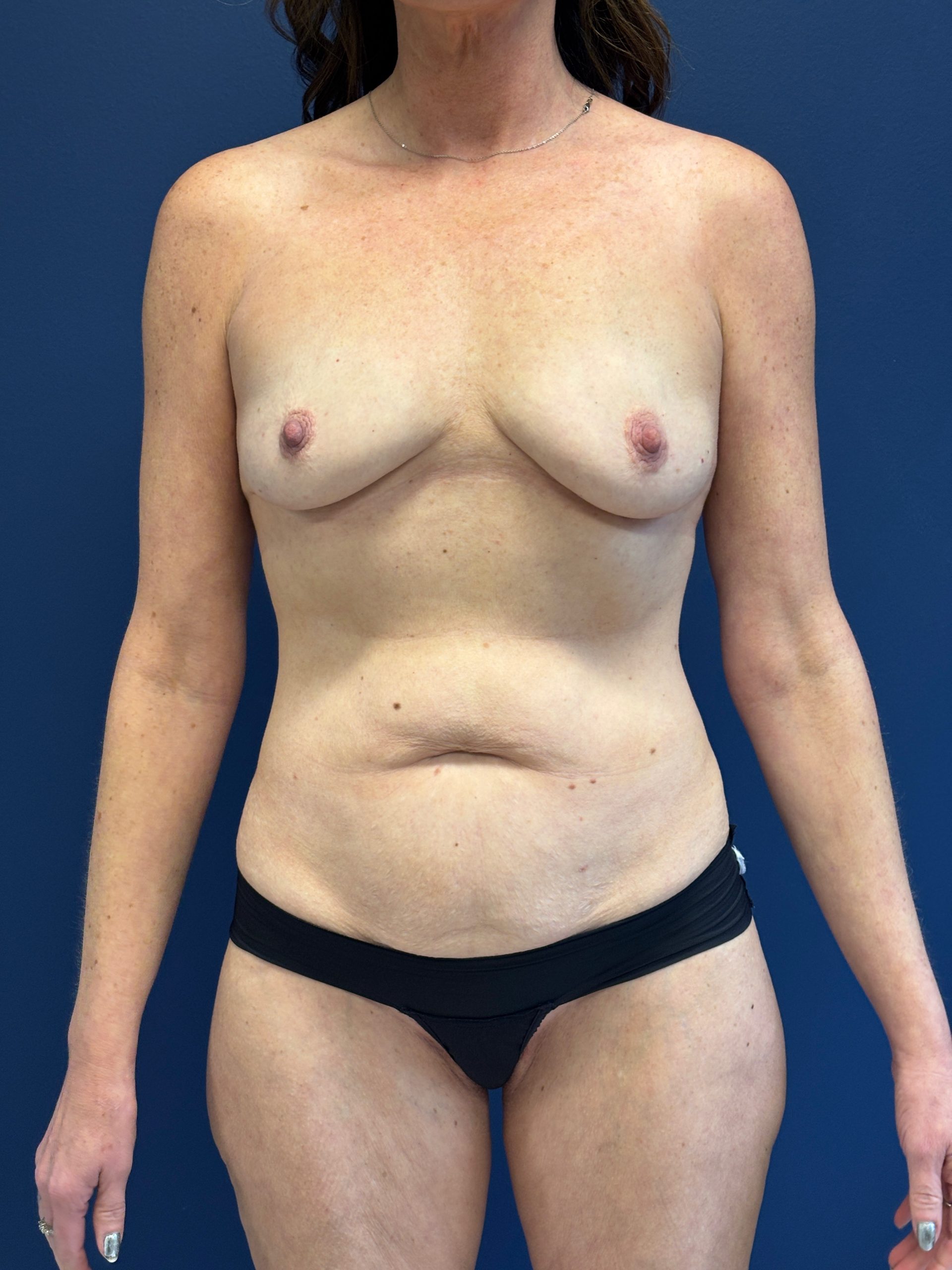 Breast-Augmentation-Case--3669 | Before Breast Augmentation 1