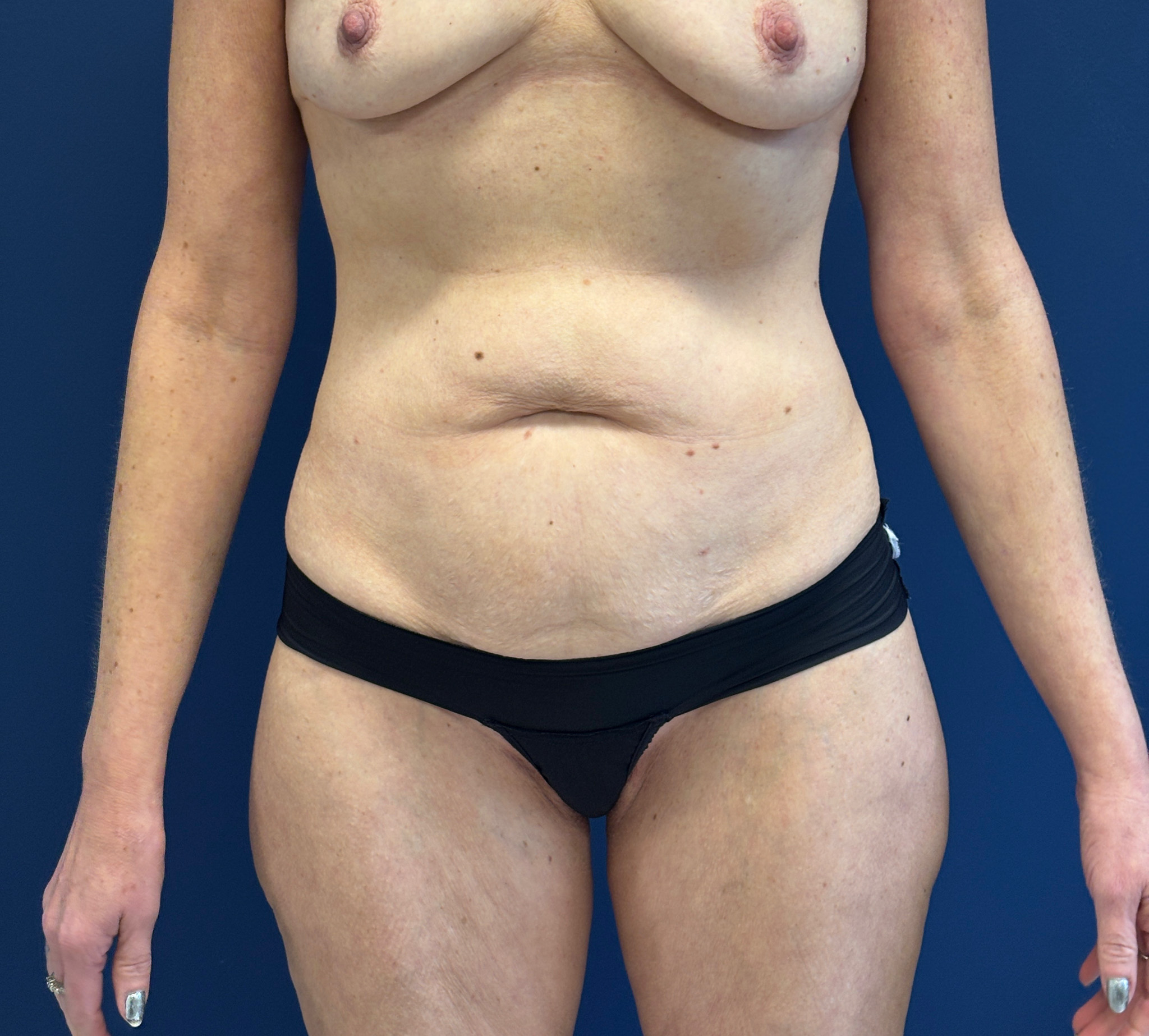 Liposuction-Case--3054 | Before Dr. Frank Albino 1