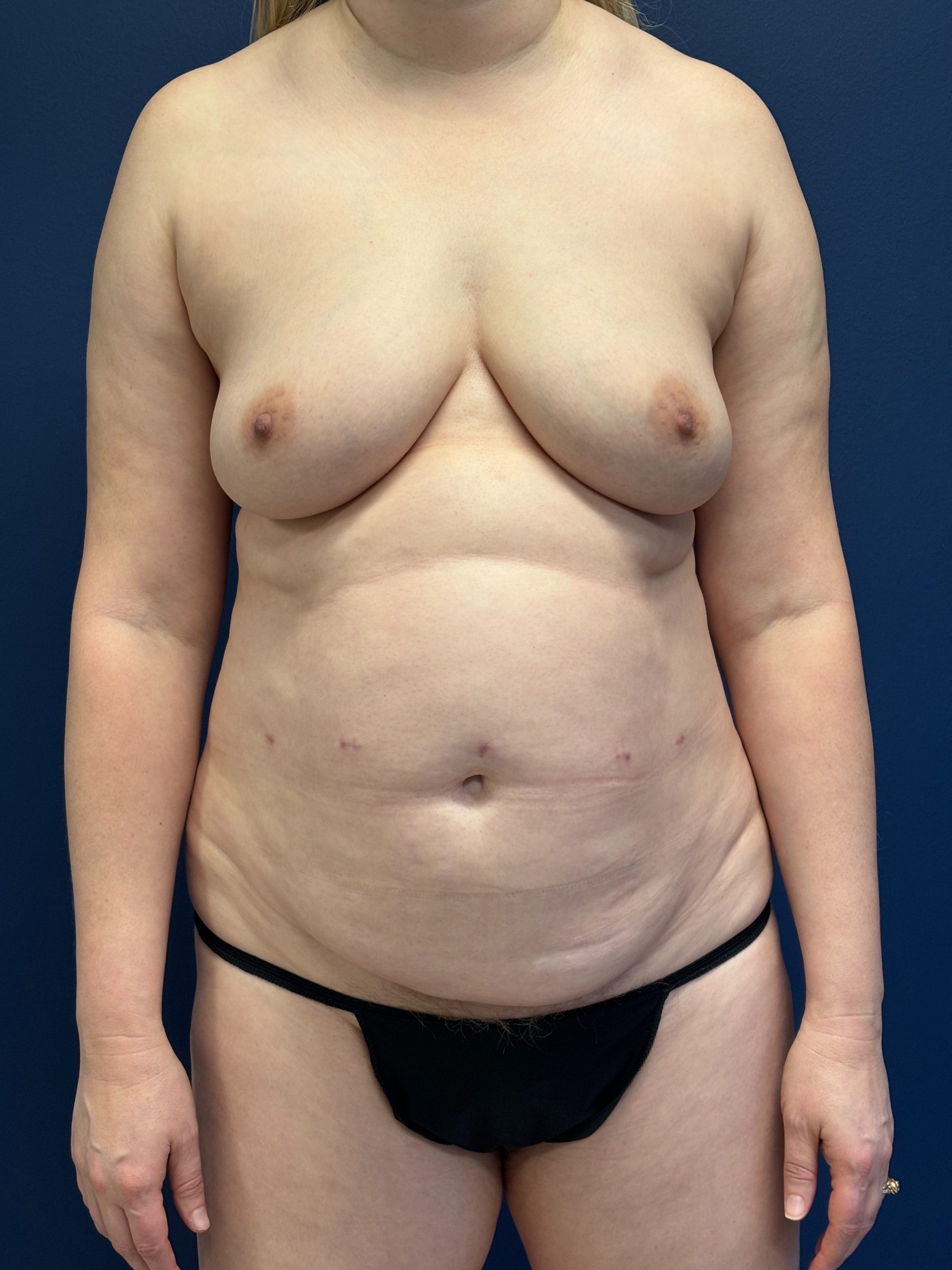 Lipoabdominoplasty-Case--3335 | Before Liposuction 1