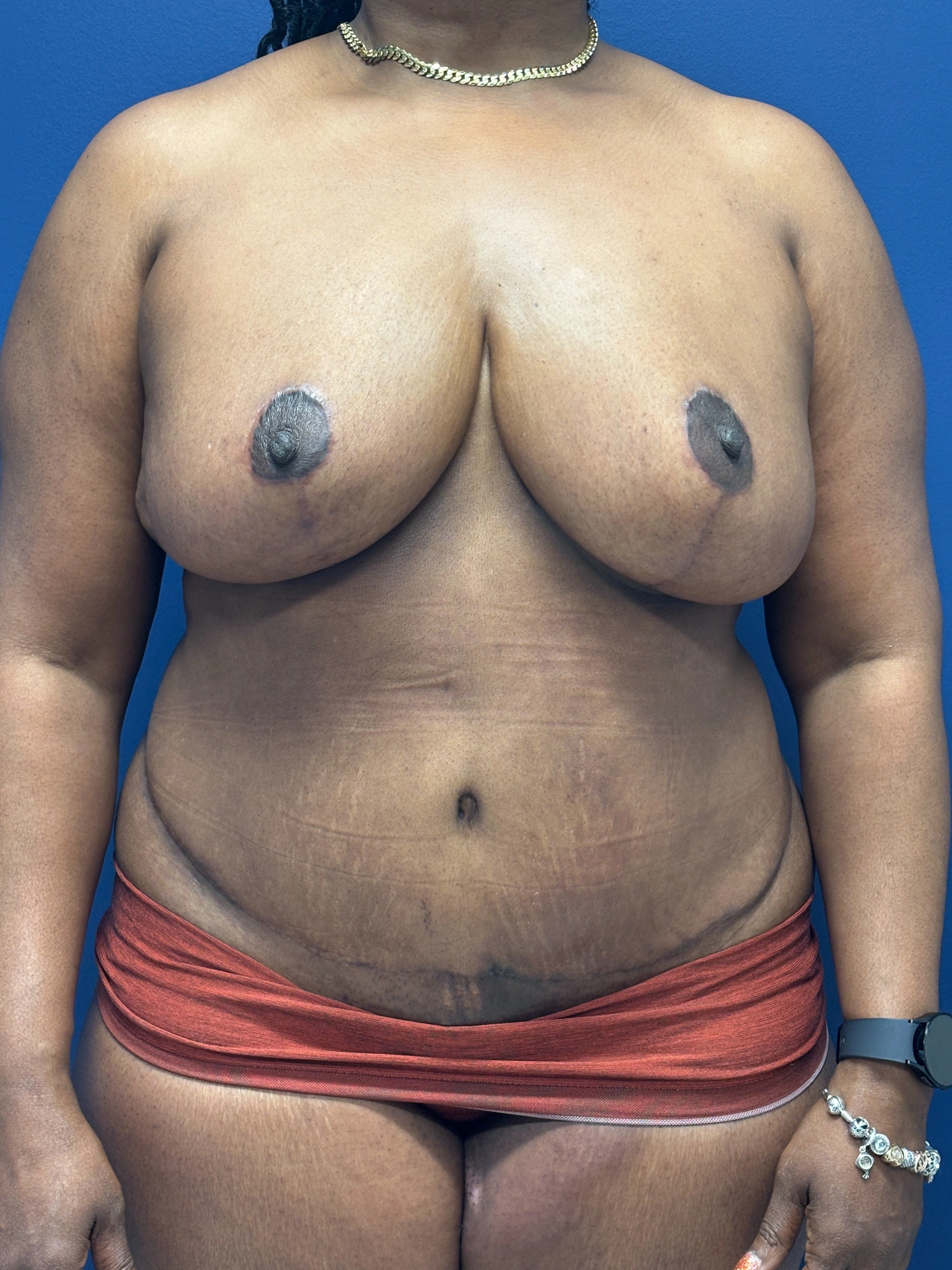 Abdominoplasty-Case--5907 | After Body 1