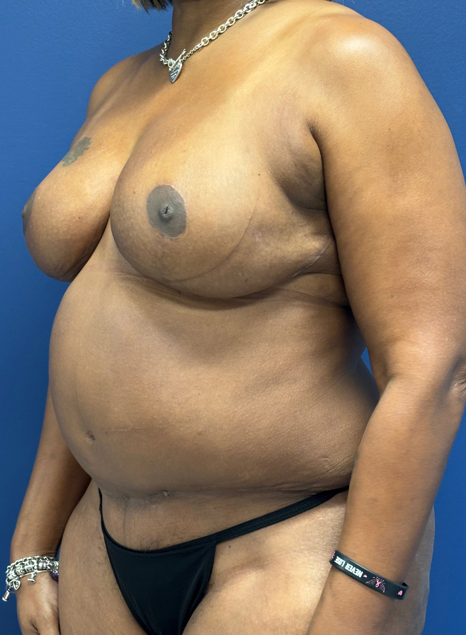 Breast-Reduction-Case--4053 | After Breast Reduction 2