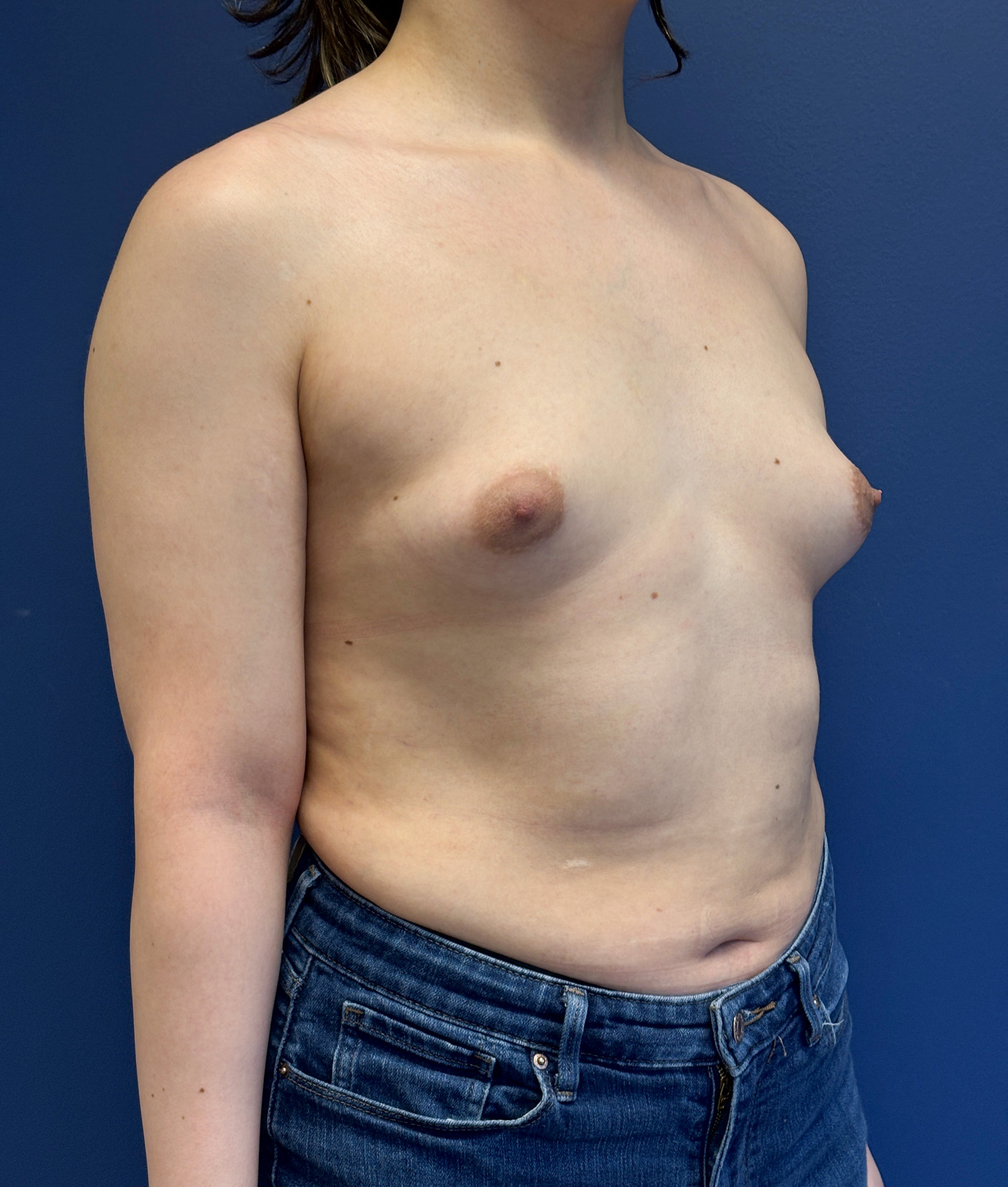 Breast-Augmentation-Case--2719 | Before Breast Augmentation 5