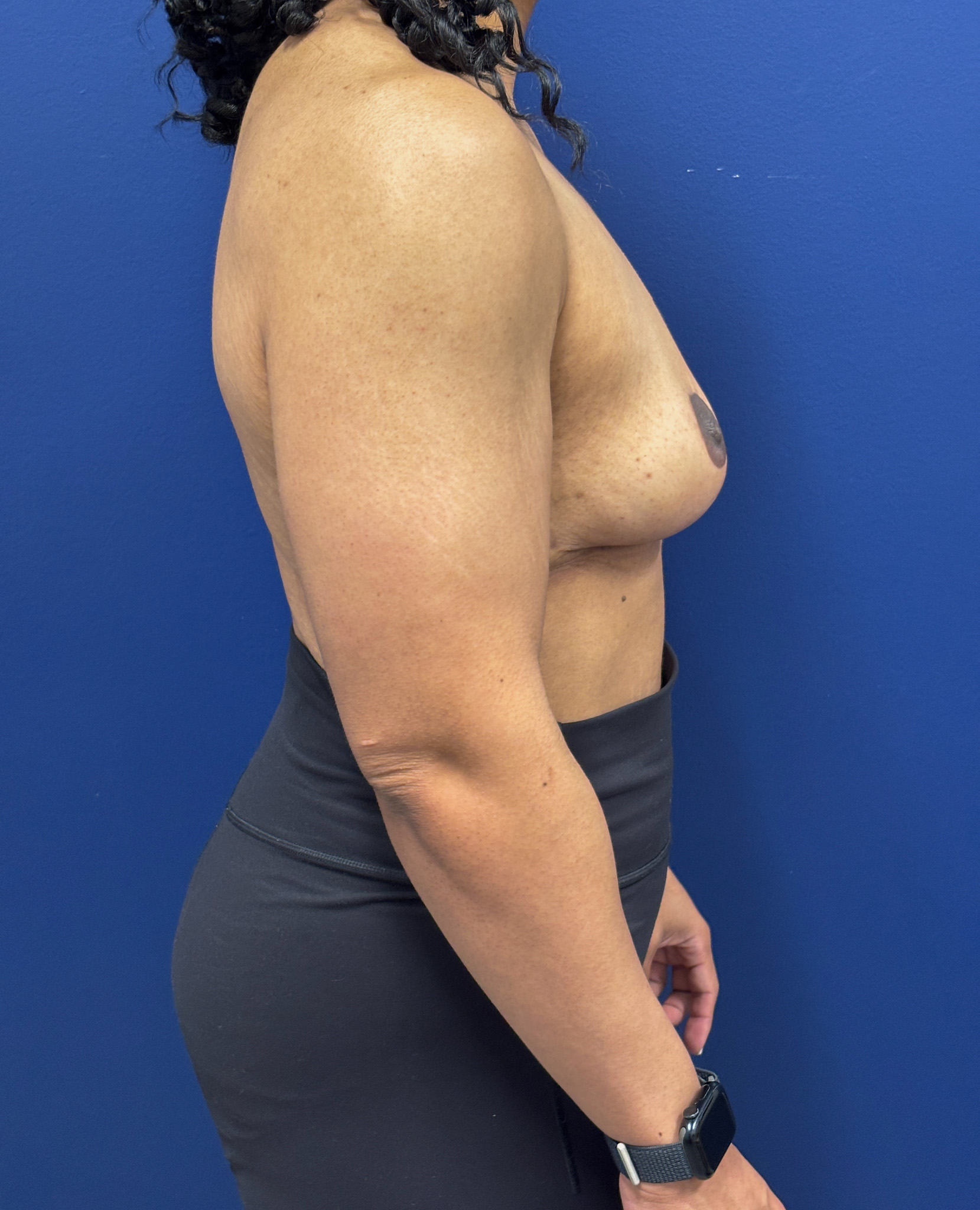 Breast-Reduction-Case--7345 | After Breast Reduction 2