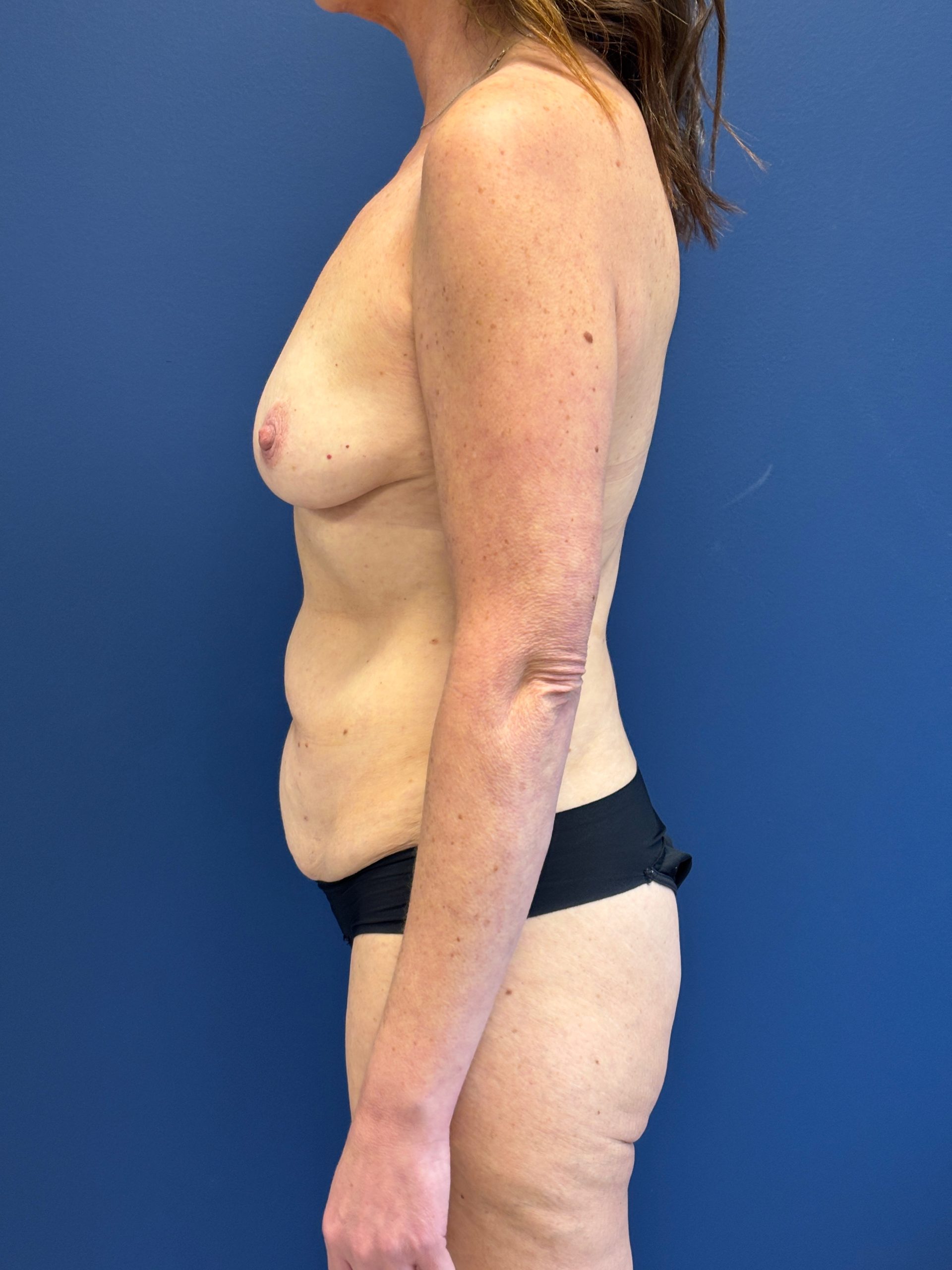 Breast-Augmentation-Case--3669 | Before Breast Augmentation 2