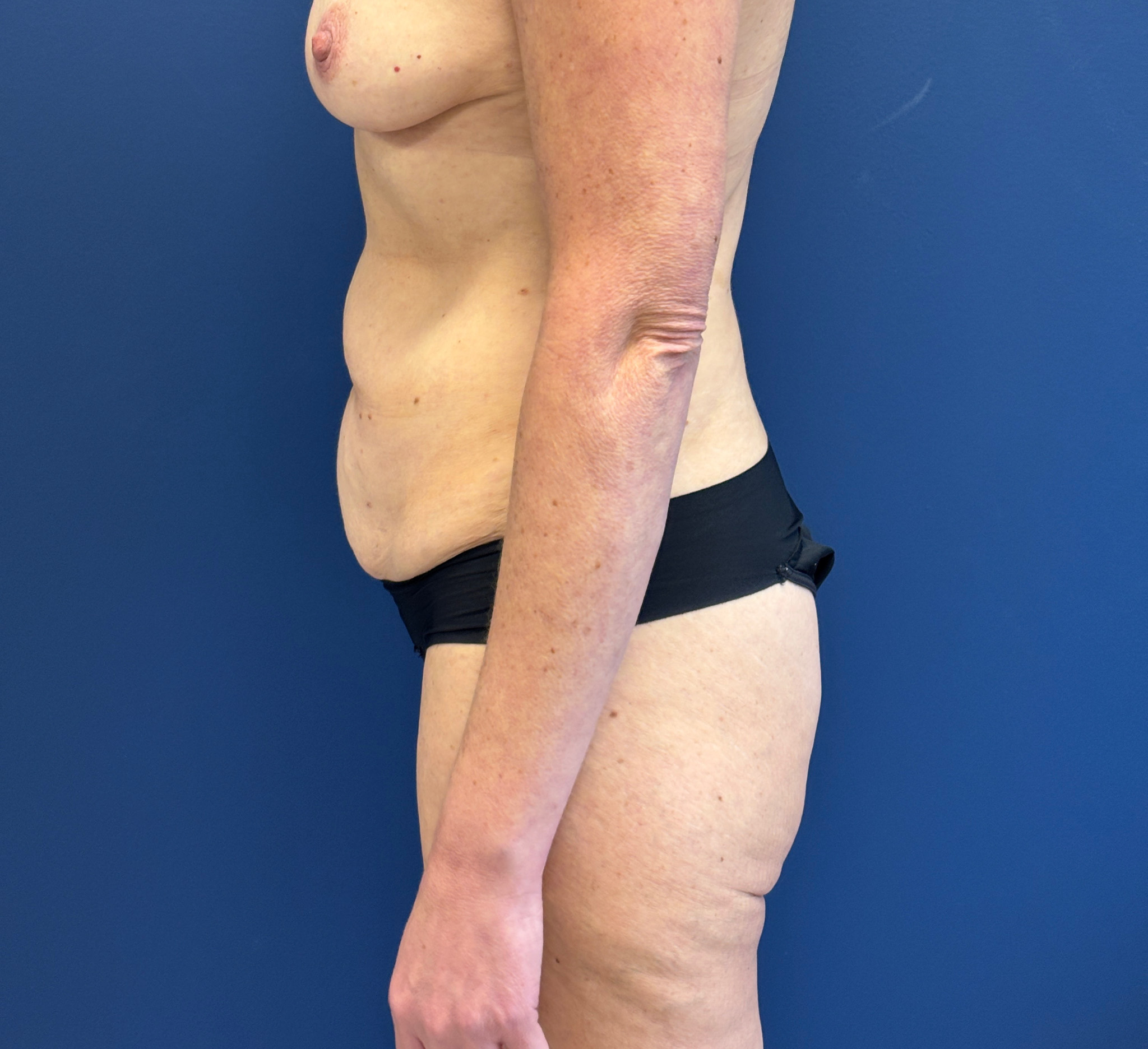 Liposuction-Case--3054 | Before Dr. Frank Albino 2