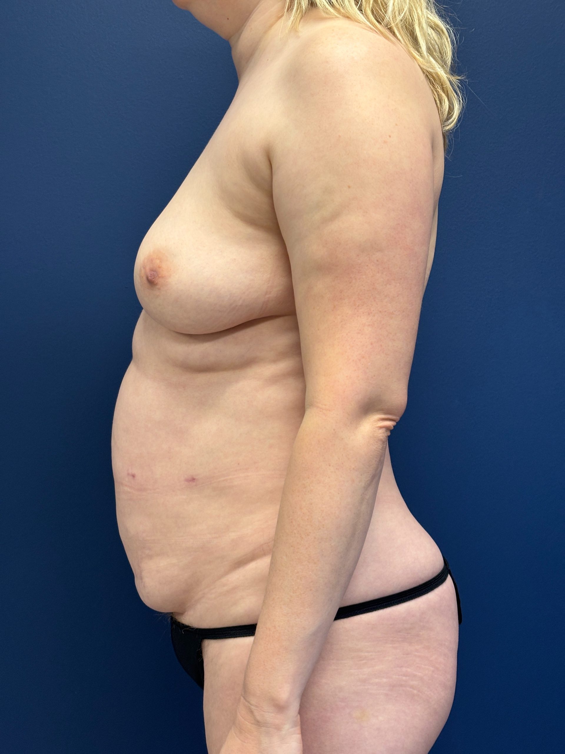 Lipoabdominoplasty-Case--3335 | Before Liposuction 2