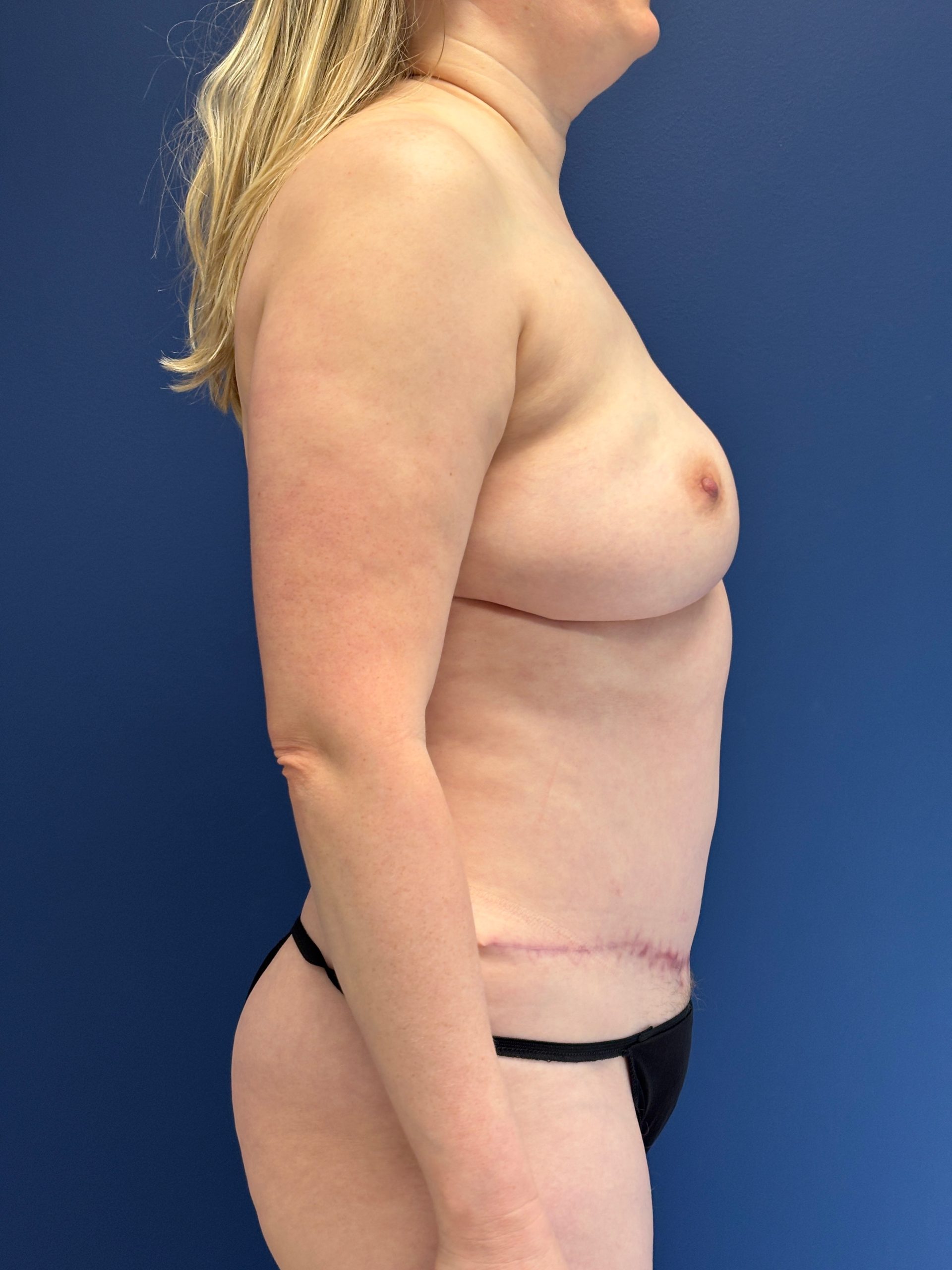 Lipoabdominoplasty-Case--3335 | After Liposuction 6