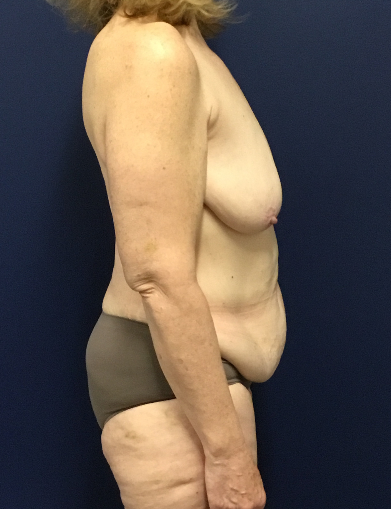 Abdominoplasty-Case--7412 | Before Tummy Tuck 2