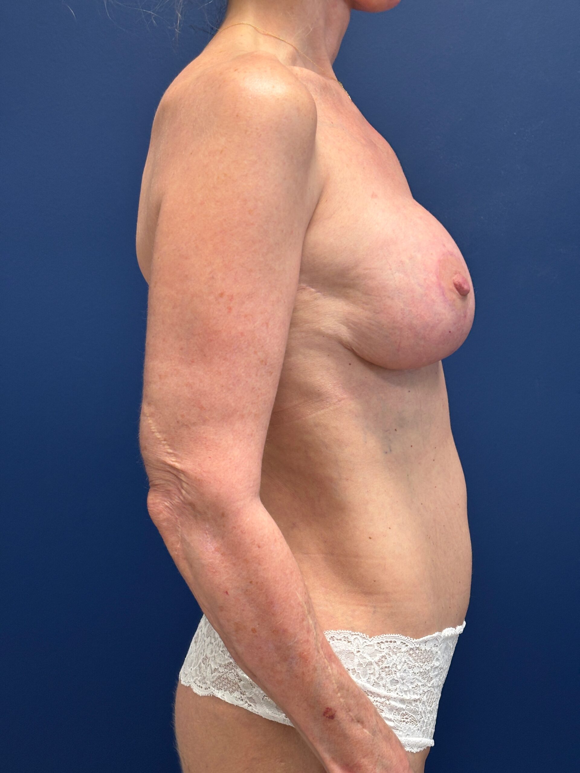Augmentation-Mastopexy-Case--7491 | After Breast Augmentation With Lift 2